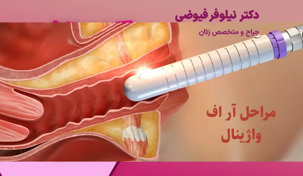مراحل آر اف واژینال