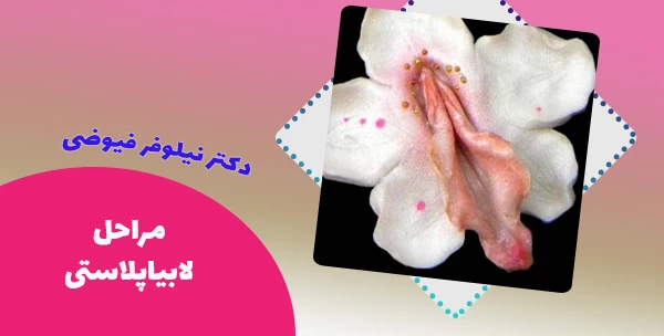 مراحل لابیاپلاستی