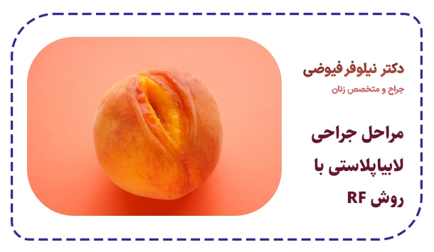 مراحل جراحی لابیاپلاستی با روش RF