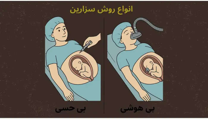 انواع روش سزارین