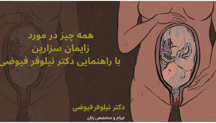 زایمان سزارین چیست