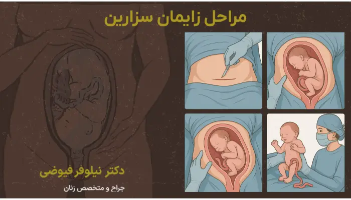 مراحل زایمان سزارین
